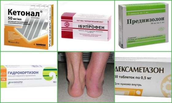 Методы лечения ахиллобурсита