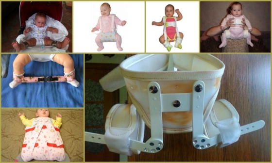 Методы лечения дисплазии тазобедренного сустава у грудничков