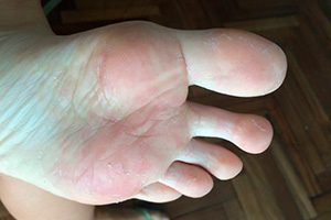 Микотическая экзема на ногах