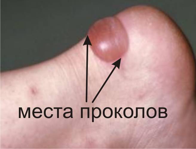 Водяная мозоль. Места проколов.