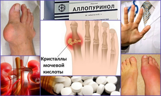 Назначение аллопуринола