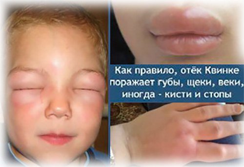 отёк Квинке