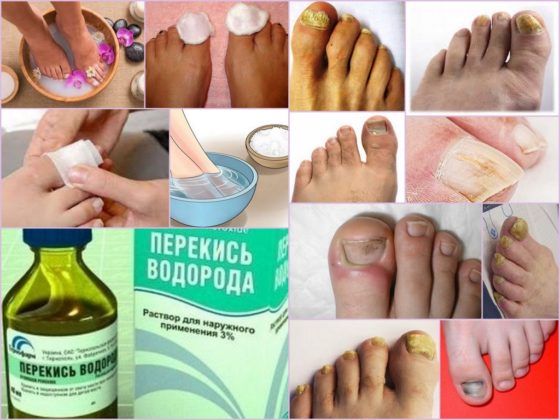 Перекись водорода от грибка