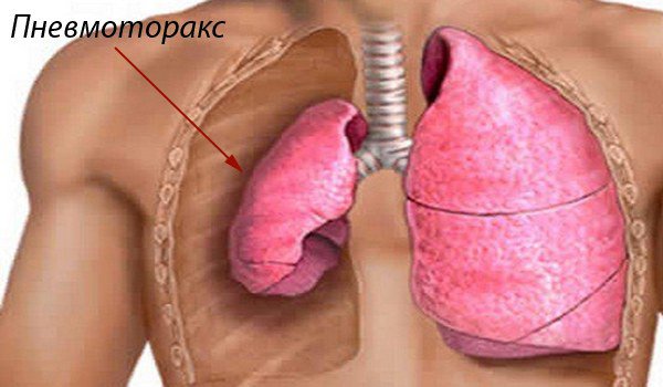 пневмоторакс