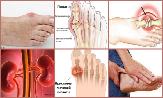Подагра – как болезнь, вид изнутри