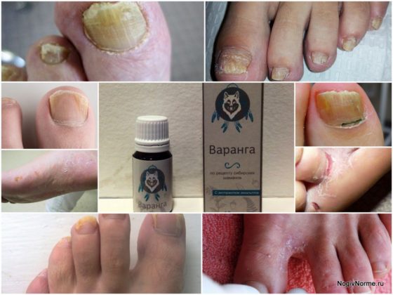 Препарат Варанга от грибка на ногах