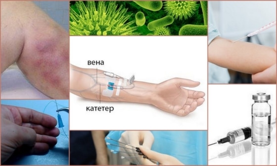 Причины постинъекционного флебита