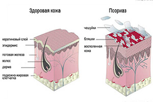 Причины возникновение псориаза