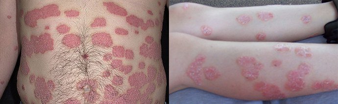 прогрессирующая стадия вульгарного псориаза
