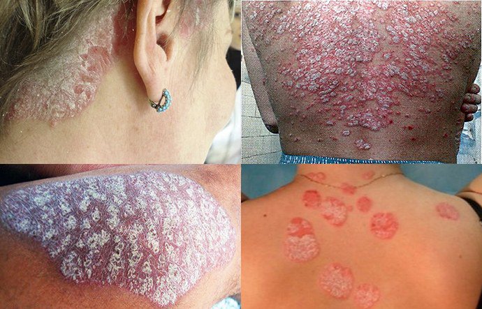 проявление псориатической эритродермии проявление псориатической эритродермии