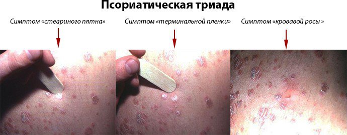 проявление псориатической триады