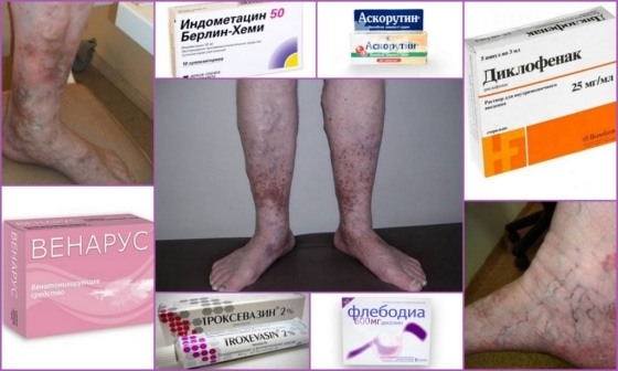 Разновидности препаратов при венозной недостаточности
