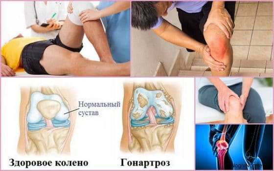 Развитие гонартроза коленного сустава
