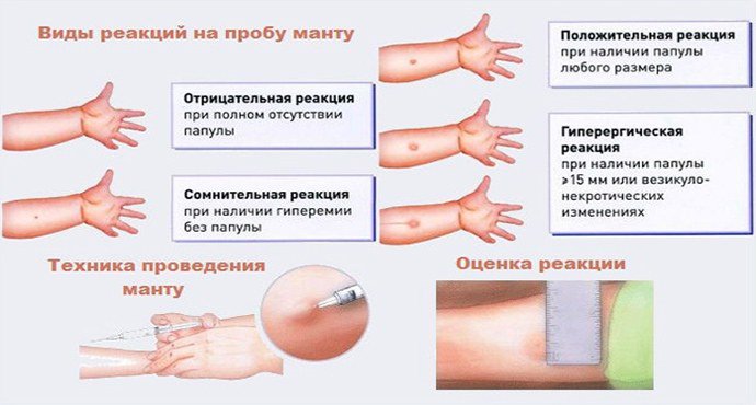 реакции на пробы манту