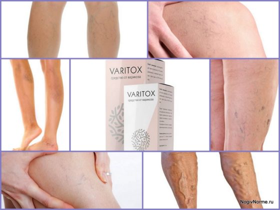 Средство Varitox от варикозного расширения вен