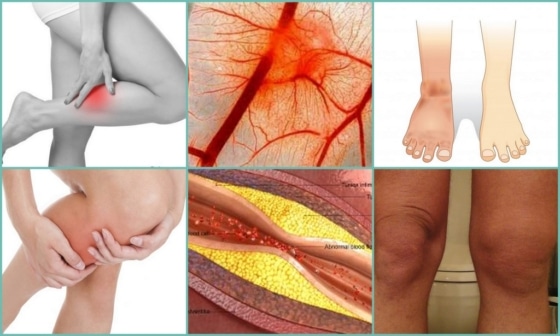 Стадии болезни Шляттера