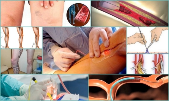 Тромбэктомия и кроссэктомия