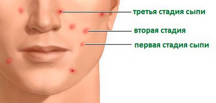 стадии развития ветрянки