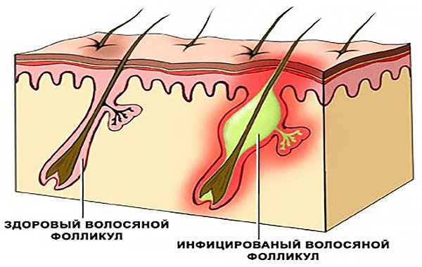 здоровый и инфицированный волосяной фолликул