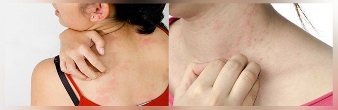 Зуд и высыпания на коже Зуд и высыпания на коже